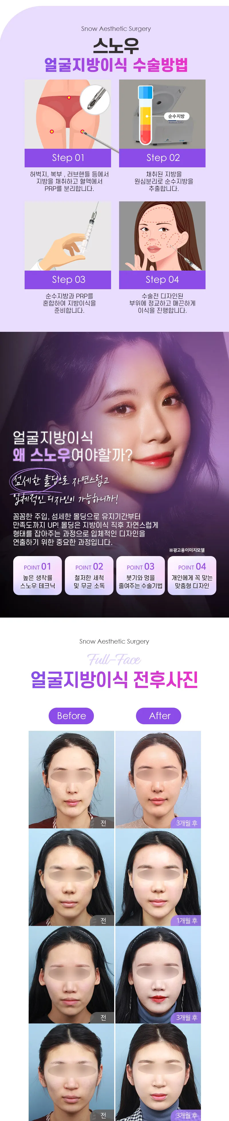 스노우의원 PRP 얼굴지방이식 이벤트, 시술 상세 이미지
