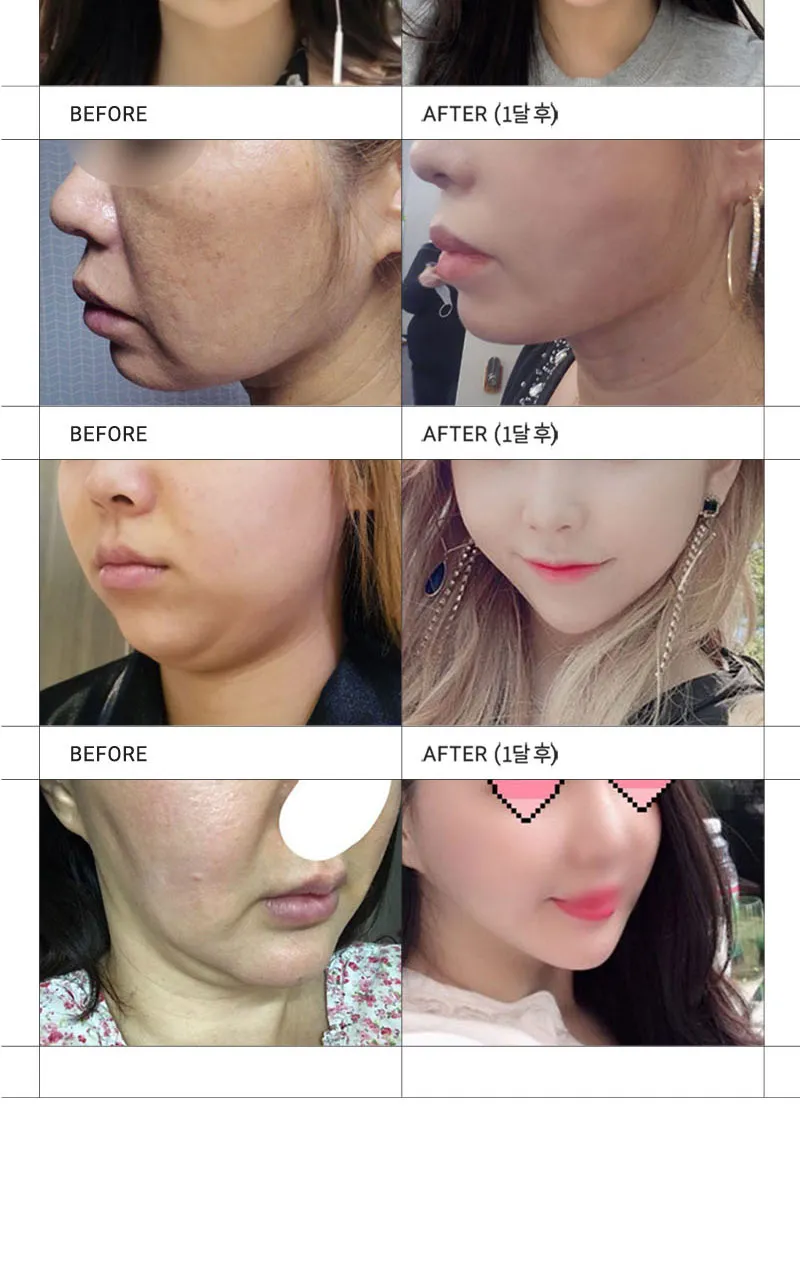 순플러스성형외과 순플러스 집착리프팅_민트실 이벤트, 시술 상세 이미지