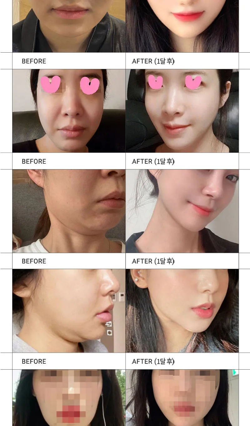 순플러스성형외과 순플러스 집착리프팅_민트실 이벤트, 시술 상세 이미지