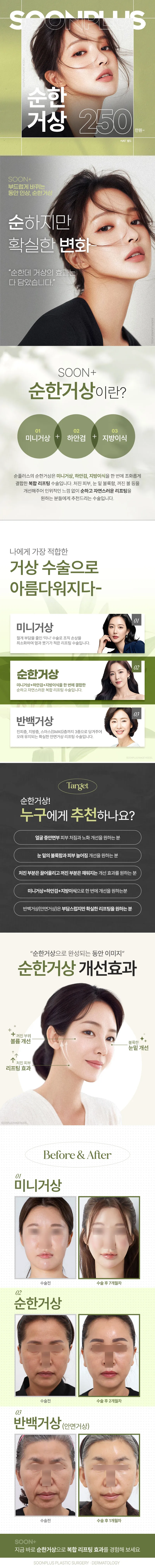 순플러스성형외과 순플러스 순한거상 이벤트, 시술 상세 이미지