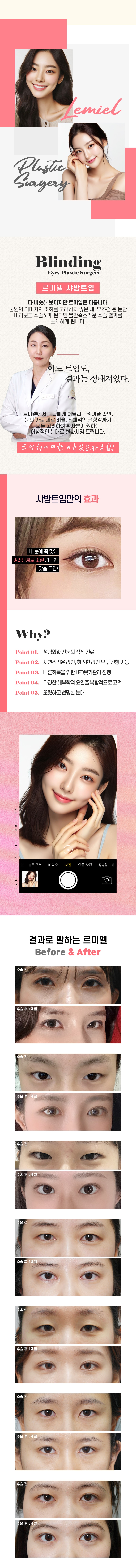 앞트임 윗트임 뒤밑트임 18년 경력 성형외과 전문의