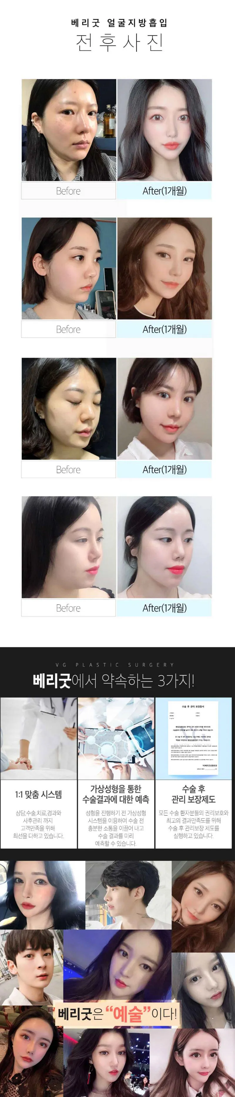 베리굿성형외과의원 베리굿♡얼굴 지방흡입 이벤트, 시술 상세 이미지
