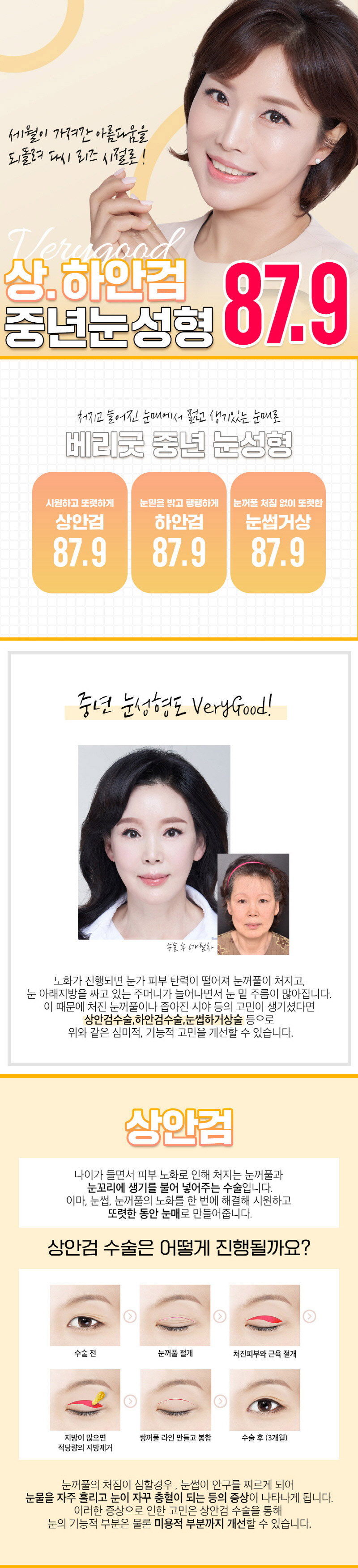 베리굿성형외과의원 베리굿 ♡ 중년 눈성형 이벤트, 시술 상세 이미지