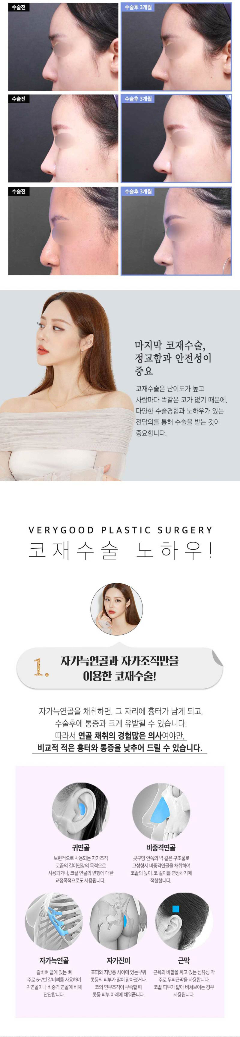 베리굿성형외과의원 베리굿♡코재수술 이벤트, 시술 상세 이미지