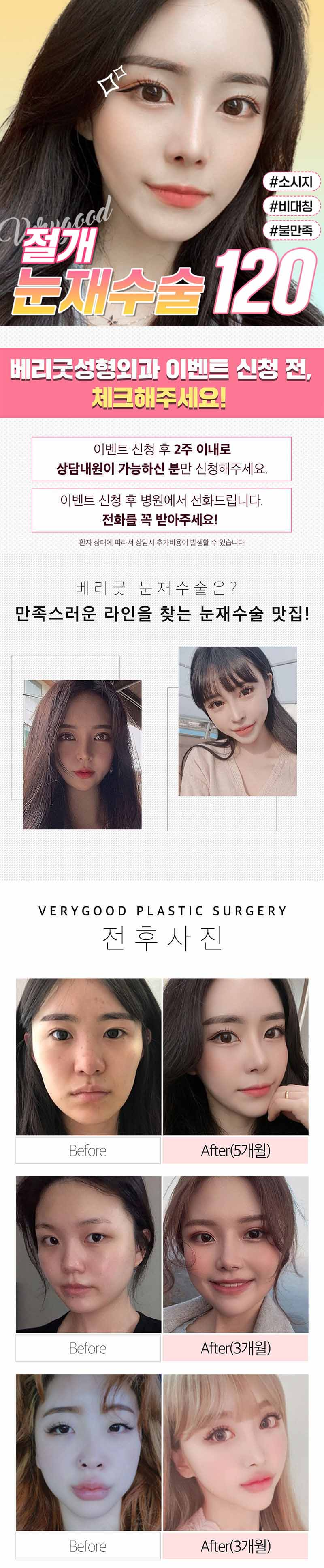 베리굿성형외과의원 베리굿♡절개 눈재수술 이벤트, 시술 상세 이미지