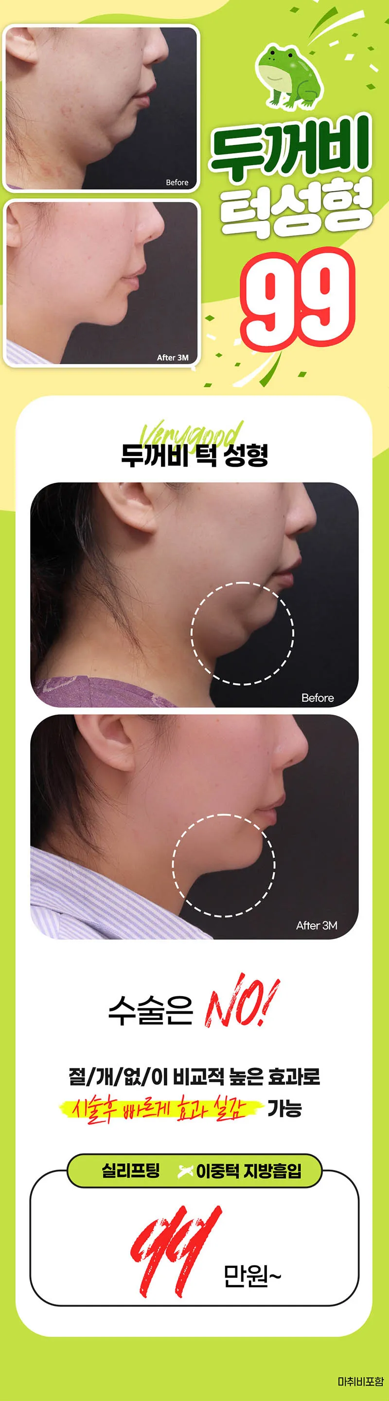 베리굿성형외과의원 베리굿♡두꺼비턱성형 이벤트, 시술 상세 이미지