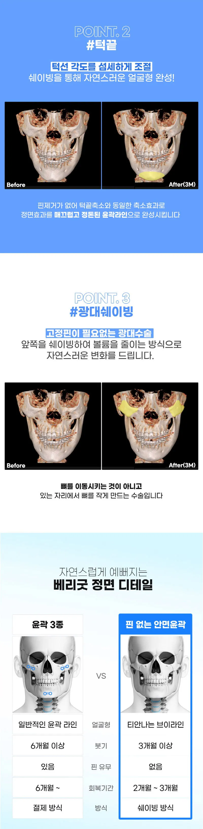 베리굿성형외과의원 핀없는 안면윤곽  이벤트, 시술 상세 이미지