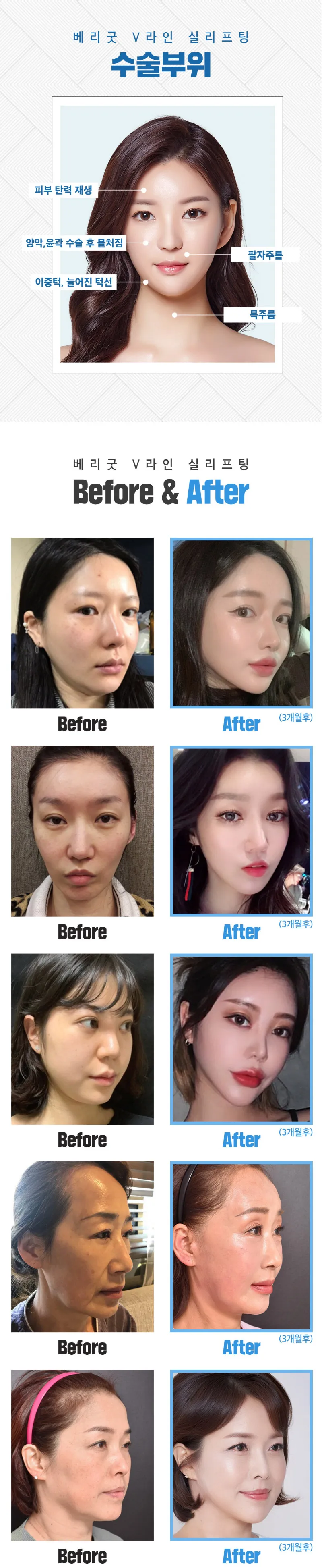 베리굿성형외과의원 베리굿♡V라인 실리프팅 이벤트, 시술 상세 이미지