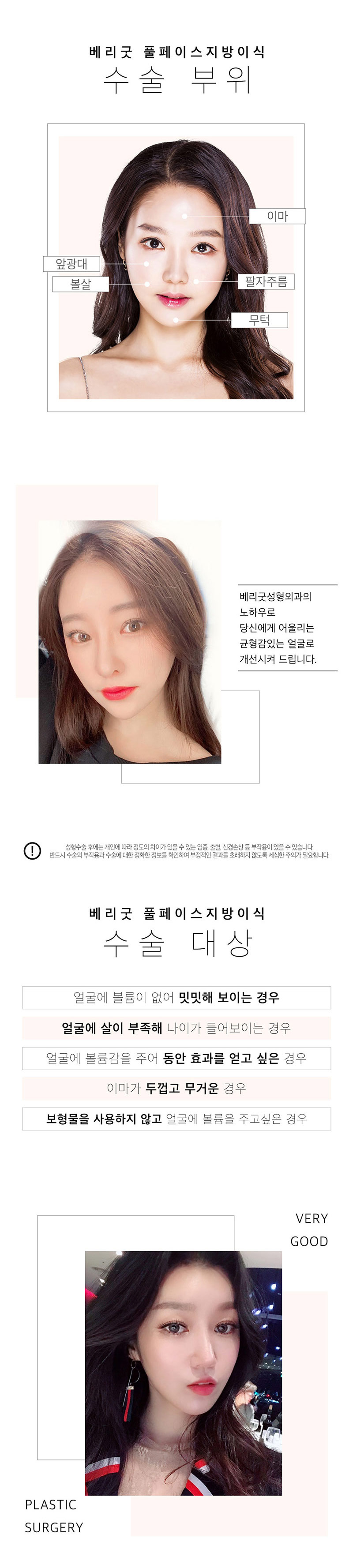 베리굿성형외과의원 베리굿♡풀페이스 지방이식 이벤트, 시술 상세 이미지