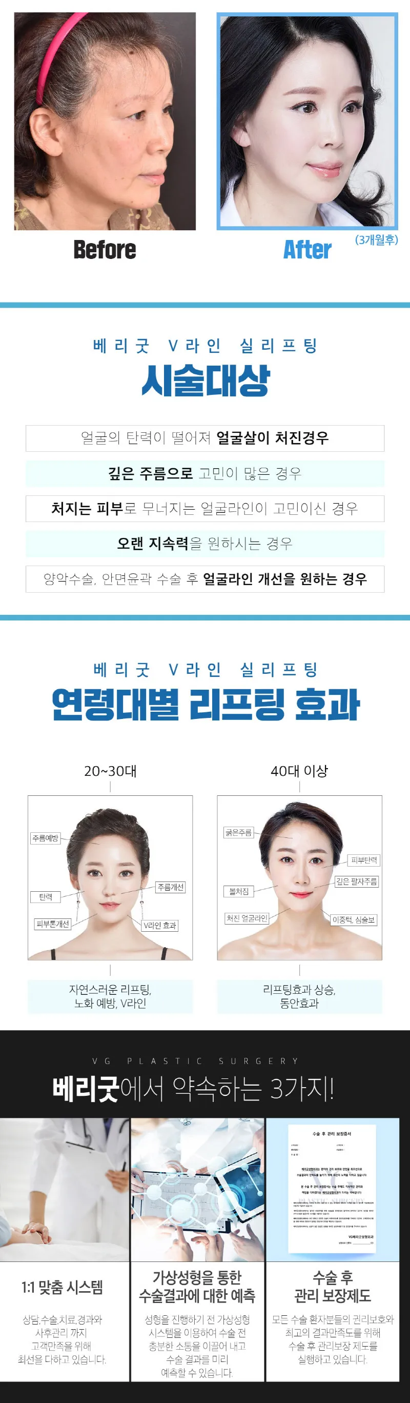 베리굿성형외과의원 베리굿♡V라인 실리프팅 이벤트, 시술 상세 이미지