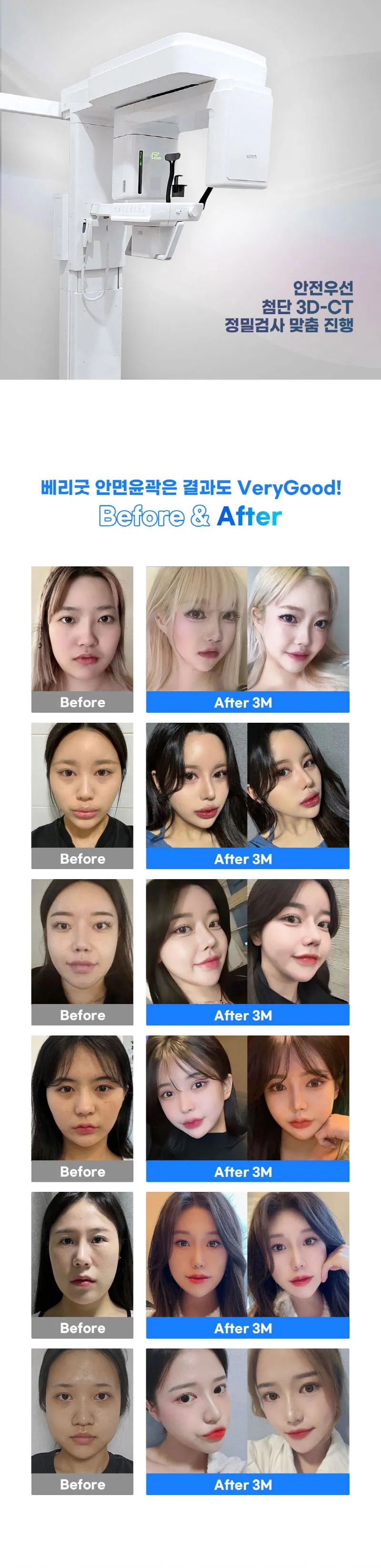 베리굿성형외과의원 핀없는 안면윤곽  이벤트, 시술 상세 이미지