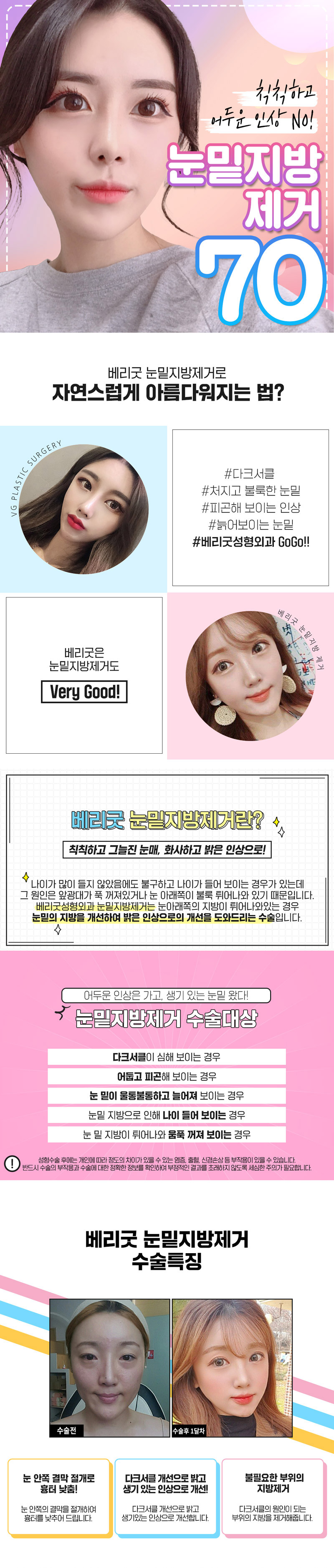 베리굿성형외과의원 베리굿 눈밑지방제거  이벤트, 시술 상세 이미지