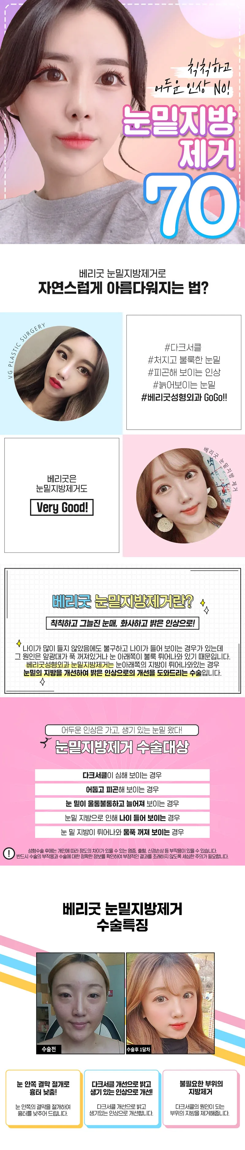 베리굿성형외과의원 베리굿 눈밑지방제거 이벤트, 시술 상세 이미지