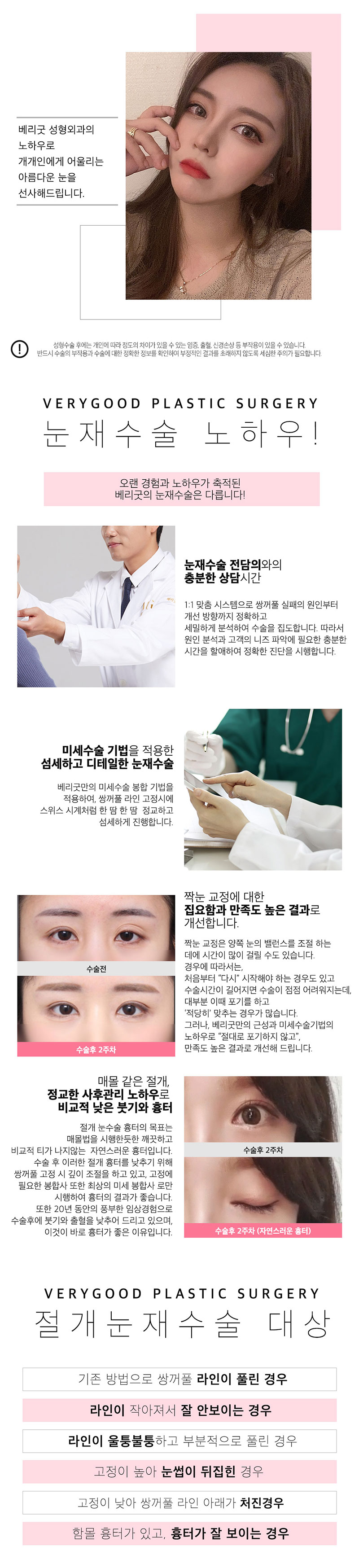 베리굿성형외과의원 베리굿♡절개 눈재수술 이벤트, 시술 상세 이미지