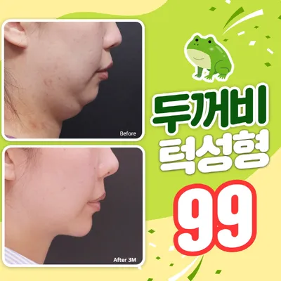 베리굿♡두꺼비턱성형 이벤트 썸네일 이미지
