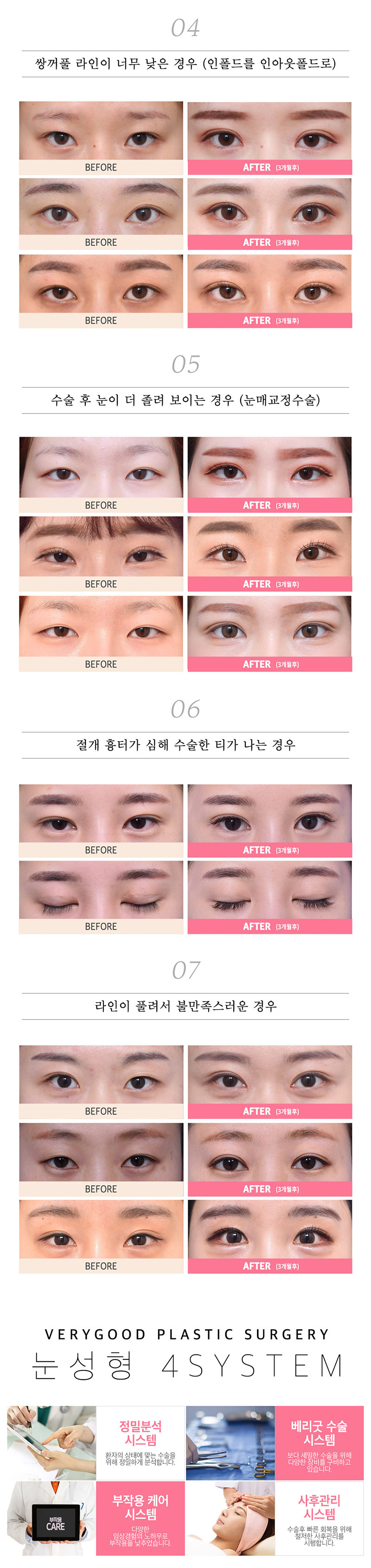 베리굿성형외과의원 베리굿♡절개 눈재수술 이벤트, 시술 상세 이미지
