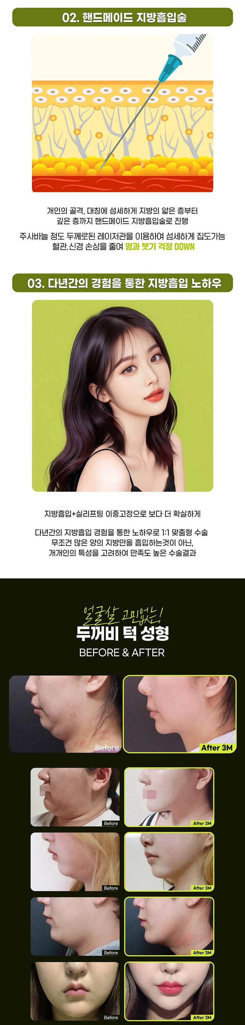 베리굿성형외과의원 베리굿♡두꺼비턱성형 이벤트, 시술 상세 이미지