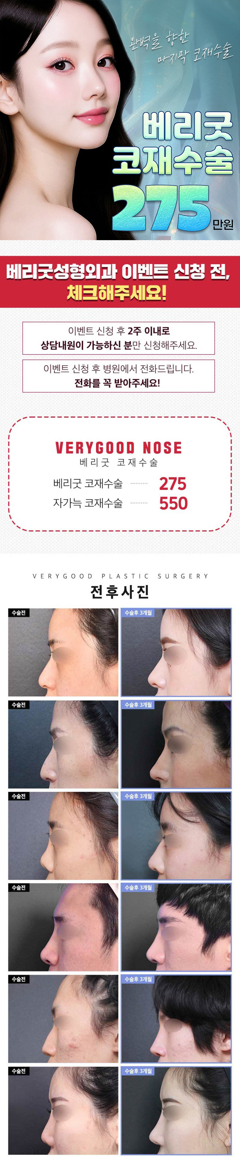 베리굿성형외과의원 베리굿♡코재수술 이벤트, 시술 상세 이미지