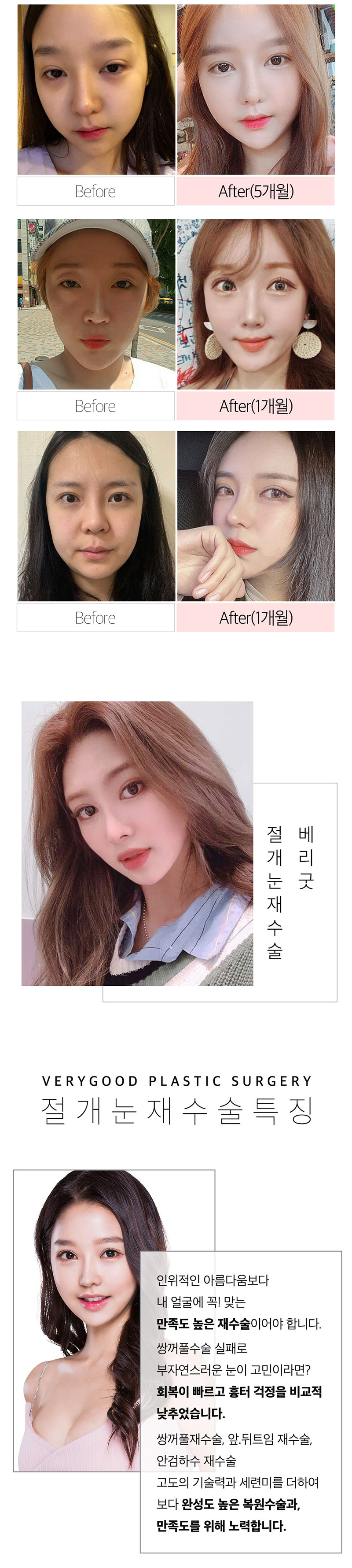 베리굿성형외과의원 베리굿♡절개 눈재수술 이벤트, 시술 상세 이미지