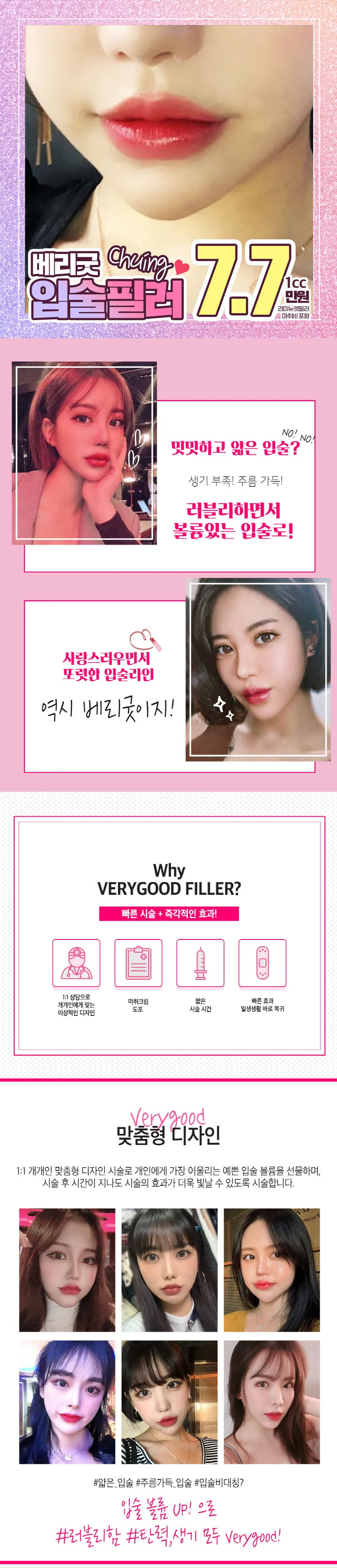 베리굿성형외과의원 베리굿♡입술필러 이벤트, 시술 상세 이미지
