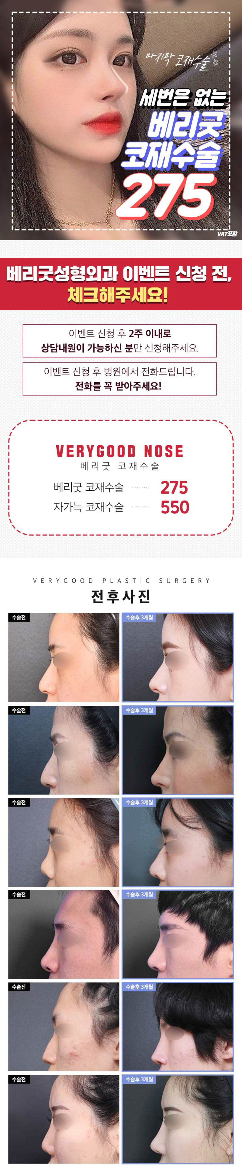 베리굿성형외과의원 베리굿♡코재수술 이벤트, 시술 상세 이미지