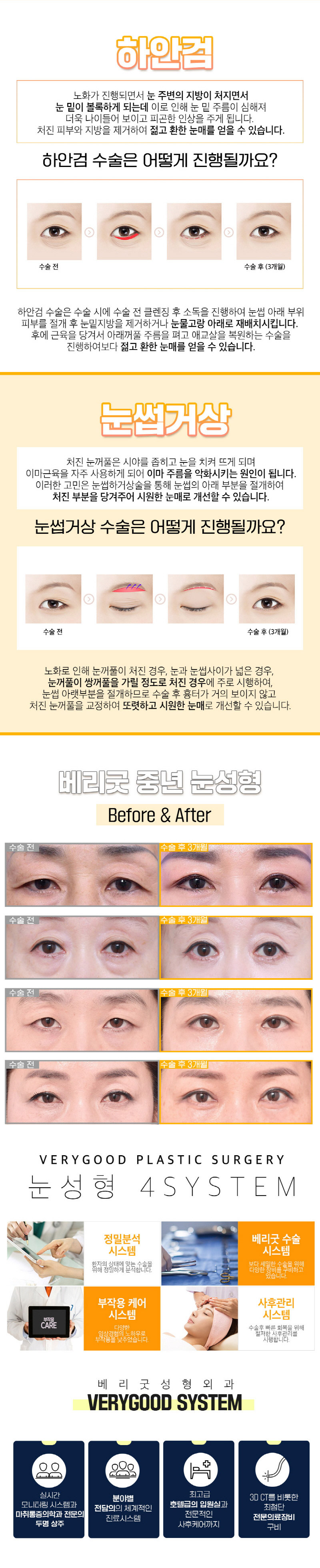 베리굿성형외과의원 베리굿 ♡ 중년 눈성형 이벤트, 시술 상세 이미지