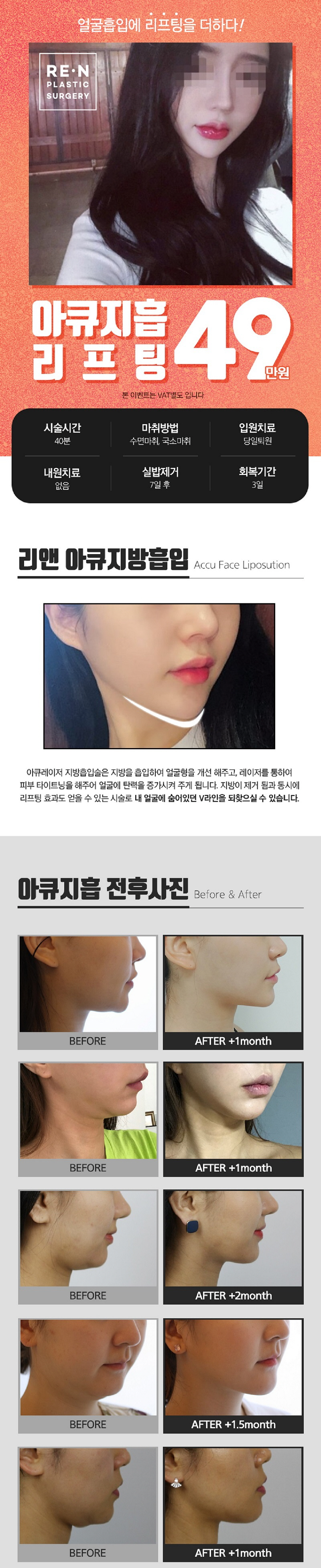 리앤성형외과의원 리앤 얼굴지방흡입 이벤트, 시술 상세 이미지