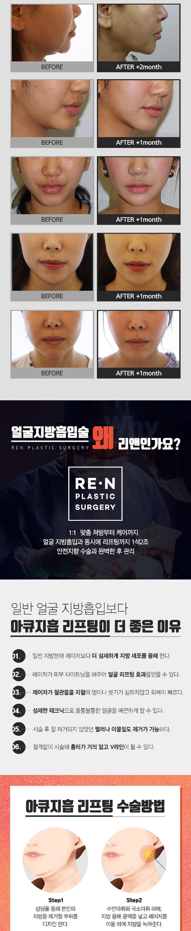 리앤성형외과의원 리앤 얼굴지방흡입 이벤트, 시술 상세 이미지