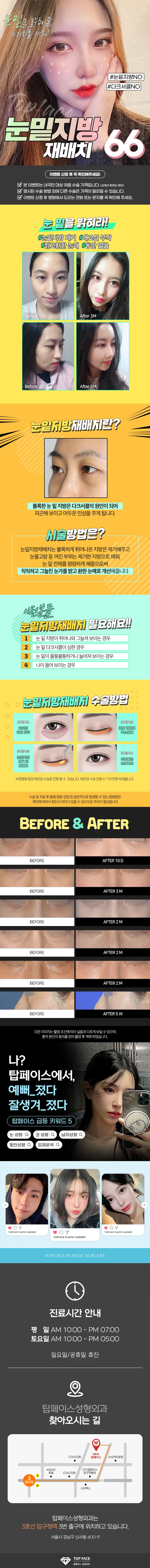 탑페이스성형외과 💖눈밑지방재배치💖 이벤트, 시술 상세 이미지