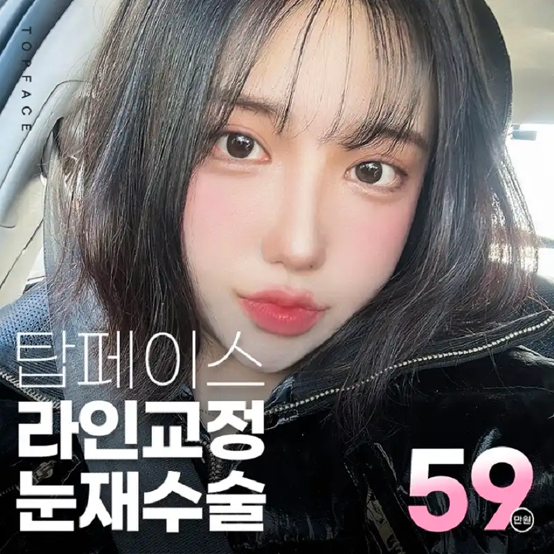 탑페이스➰#눈재수술
