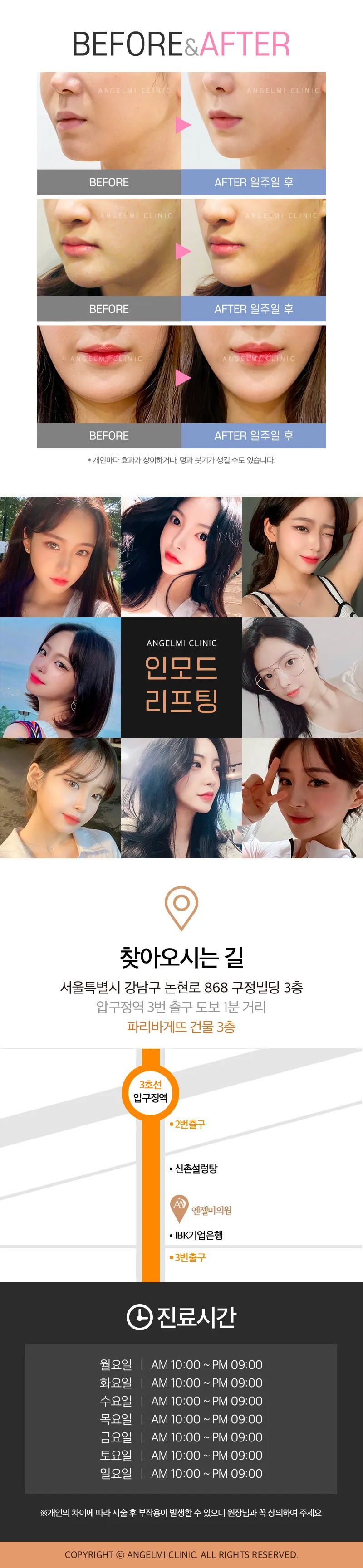 엔젤미의원 인모드리프팅 이벤트, 시술 상세 이미지