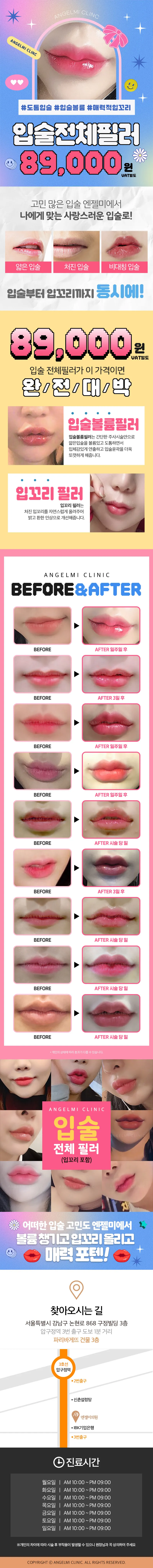 엔젤미의원 입술전체필러 이벤트, 시술 상세 이미지