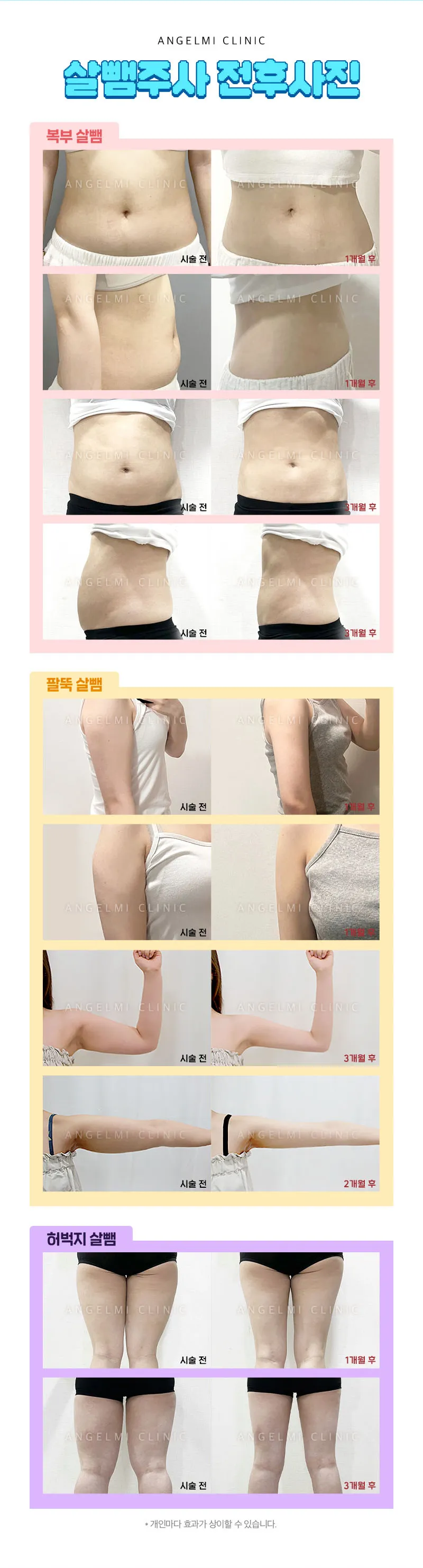 엔젤미의원 살뺌주사 대용량 이벤트, 시술 상세 이미지