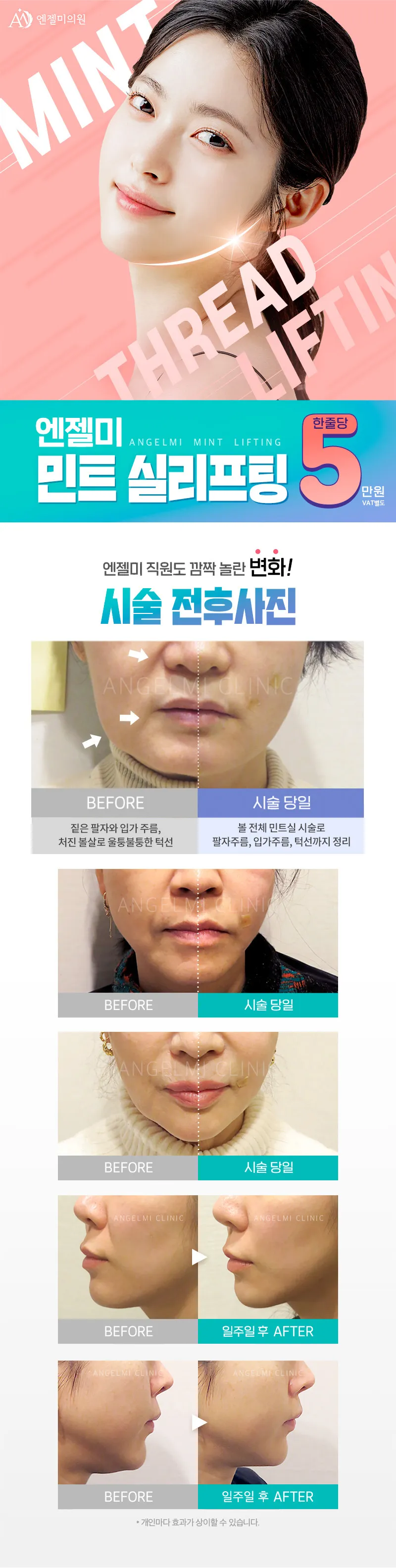 엔젤미의원 민트실리프팅 이벤트, 시술 상세 이미지