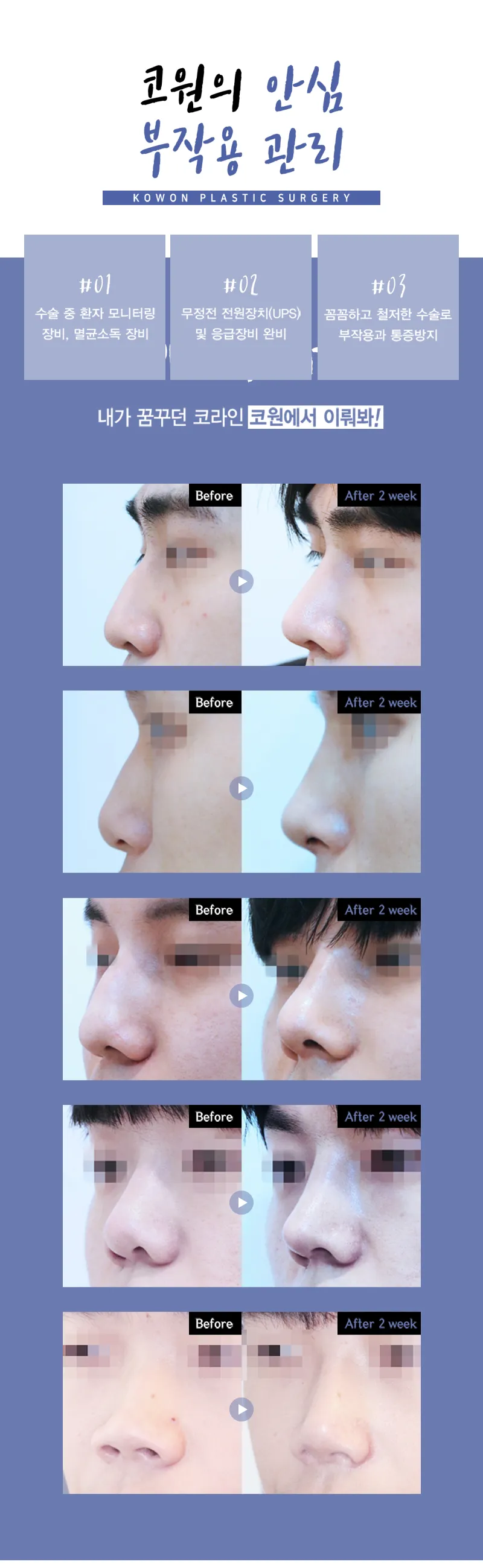 코원성형외과 남자 기능코 성형  이벤트, 시술 상세 이미지