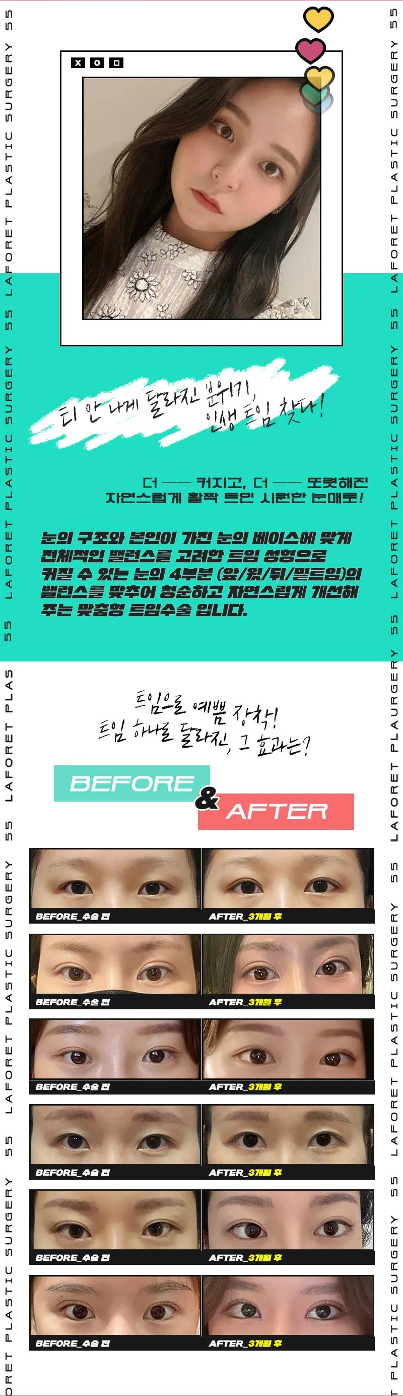 라포레성형외과 한듯안한듯 눈매로! 청순트임 이벤트, 시술 상세 이미지