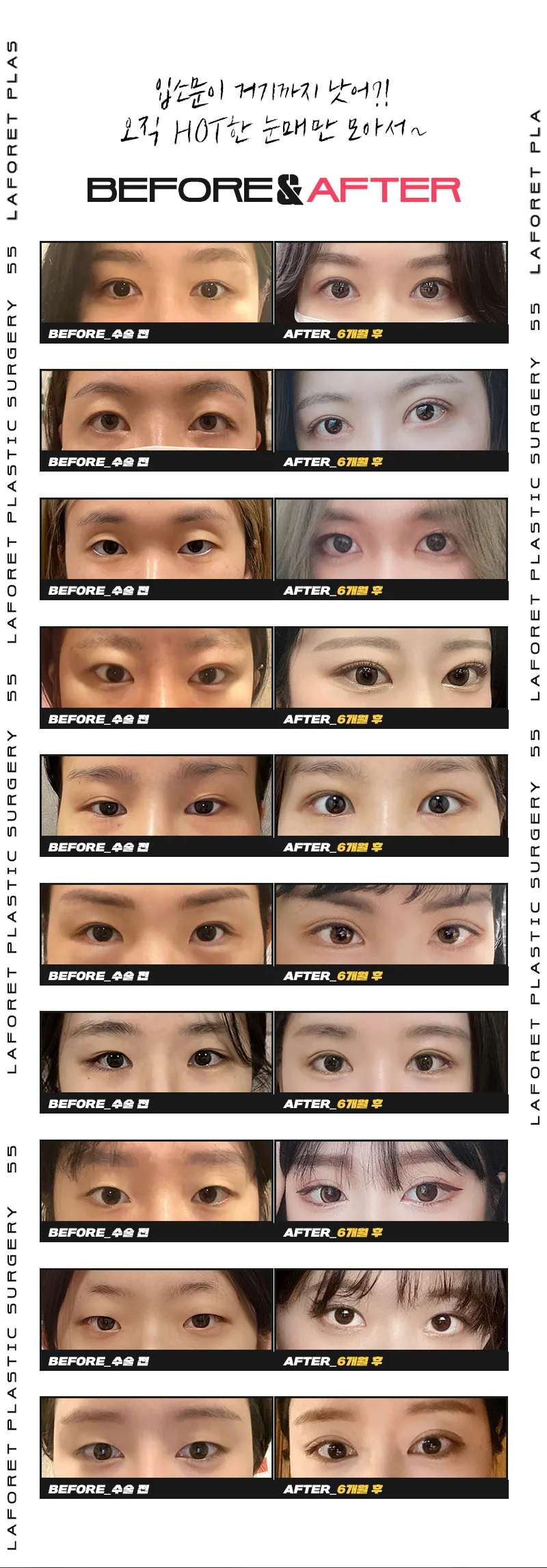라포레성형외과 자연스러운 라인! 청순쌍꺼풀 이벤트, 시술 상세 이미지