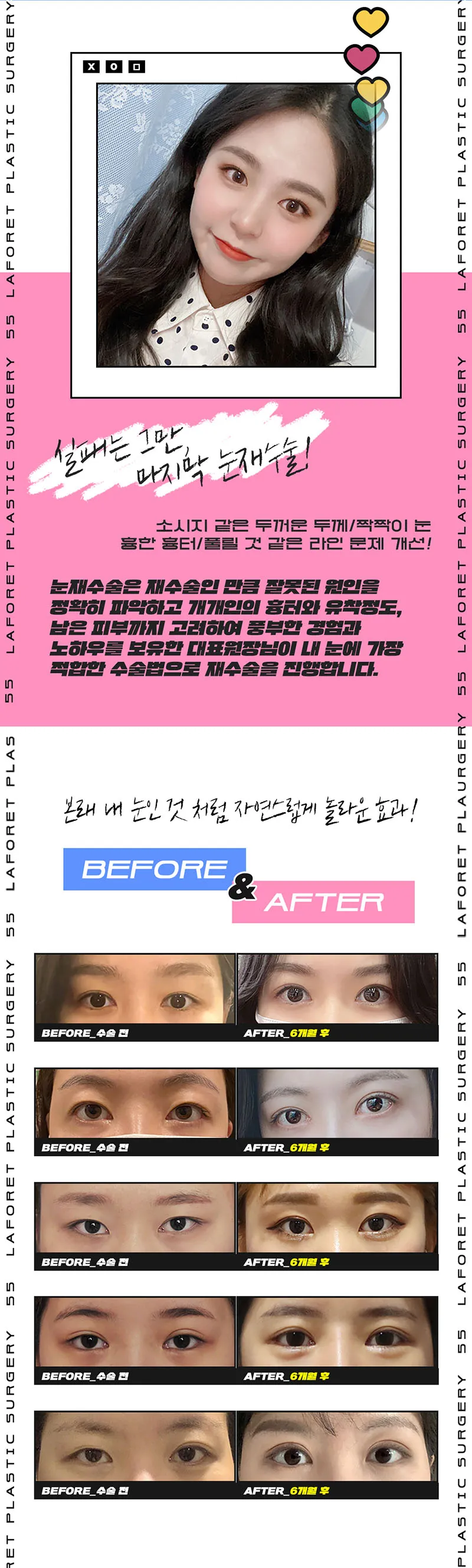 라포레성형외과 눈재수술 이벤트, 시술 상세 이미지
