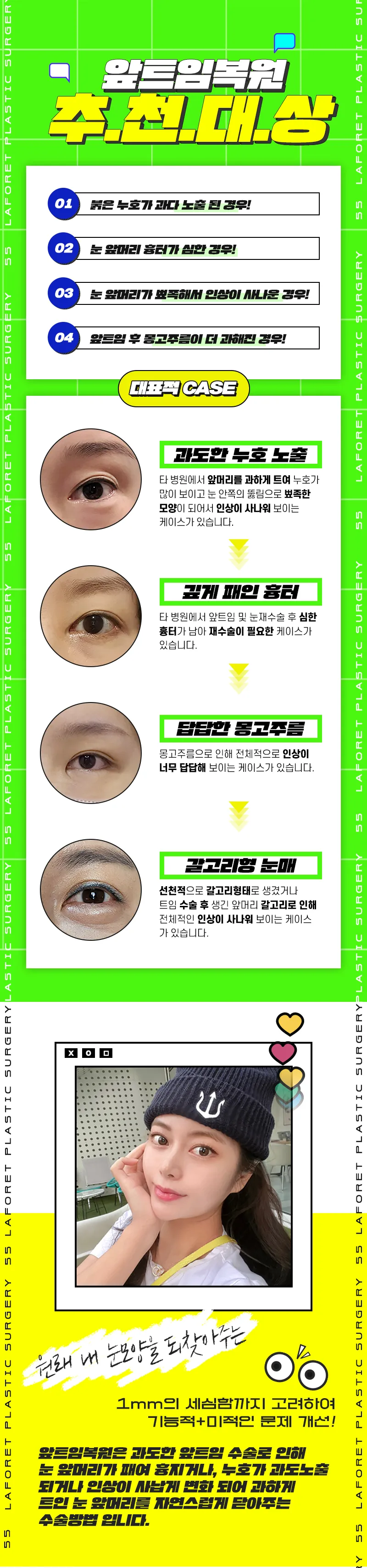라포레성형외과 1mm의 차이, 앞트임복원 이벤트, 시술 상세 이미지