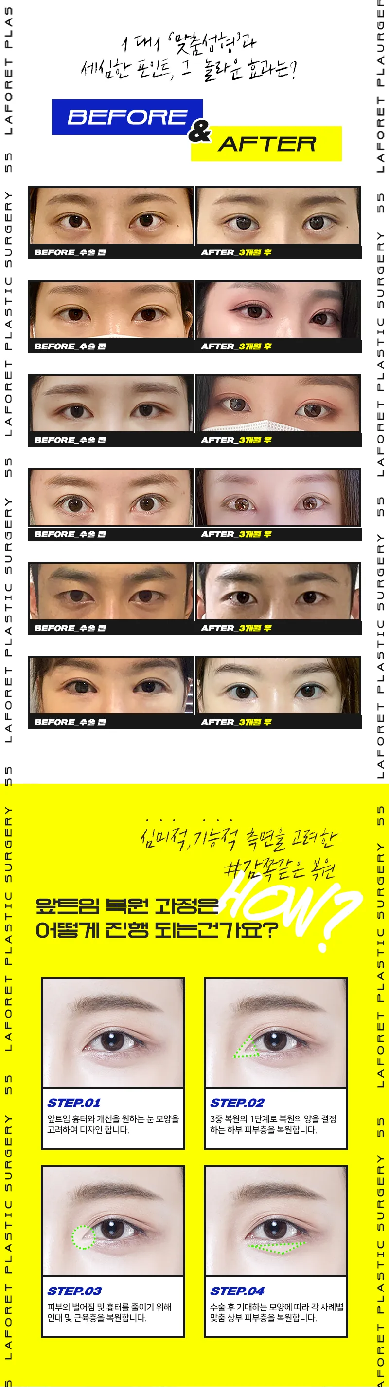 라포레성형외과 1mm의 차이, 앞트임복원 이벤트, 시술 상세 이미지