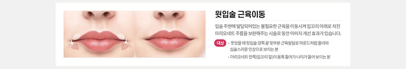 에이치비성형외과의원 흉터 걱정을 줄인 이상적인 인중성형 이벤트, 시술 상세 이미지