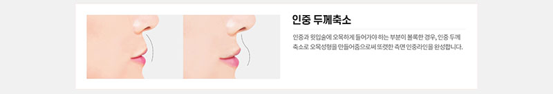 에이치비성형외과의원 흉터 걱정을 줄인 이상적인 인중성형 이벤트, 시술 상세 이미지