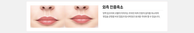 에이치비성형외과의원 흉터 걱정을 줄인 이상적인 인중성형 이벤트, 시술 상세 이미지