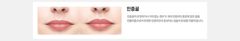 에이치비성형외과의원 흉터 걱정을 줄인 이상적인 인중성형 이벤트, 시술 상세 이미지