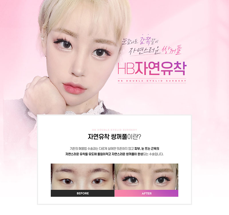 에이치비성형외과의원 자연스러운 쌍꺼풀 HB자연유착 이벤트, 시술 상세 이미지