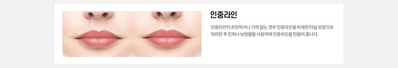 에이치비성형외과의원 흉터 걱정을 줄인 이상적인 인중성형 이벤트, 시술 상세 이미지