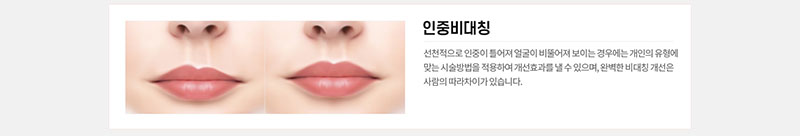 에이치비성형외과의원 흉터 걱정을 줄인 이상적인 인중성형 이벤트, 시술 상세 이미지