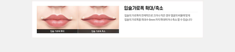 에이치비성형외과의원 흉터 걱정을 줄인 이상적인 인중성형 이벤트, 시술 상세 이미지