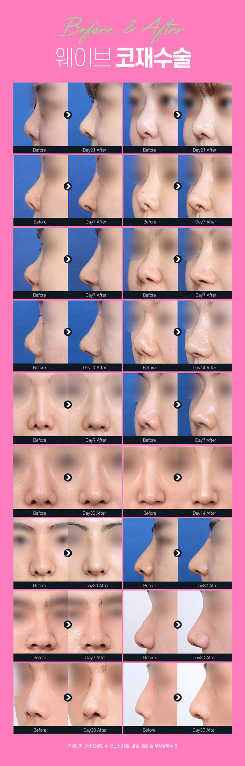 웨이브의원 👑코재수술/구축, 휜코 이벤트, 시술 상세 이미지