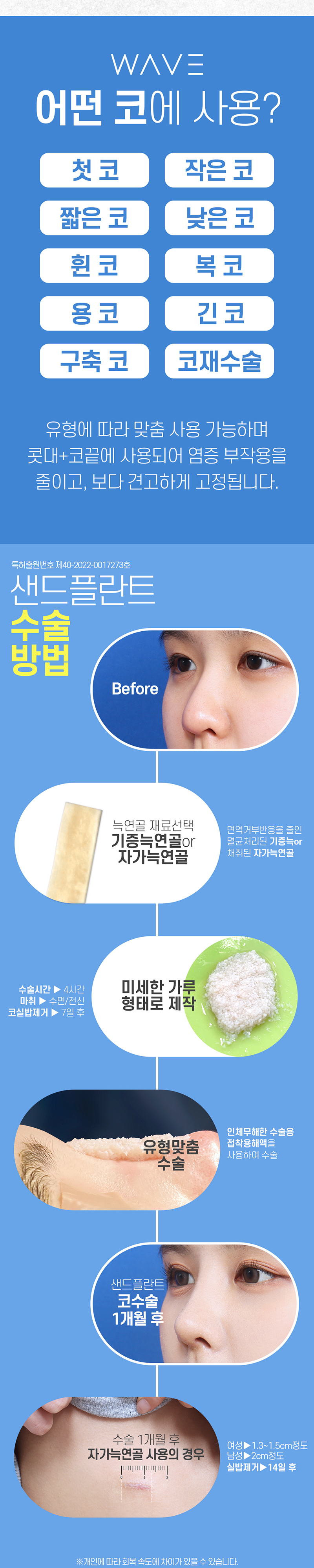 웨이브의원 무보형물 특허🥇 샌드플란트 코성형 이벤트, 시술 상세 이미지